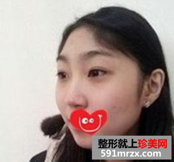 鼻部综合整形+韩式翘睫双眼皮 这下美大发了