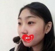 鼻部综合整形+韩式翘睫双眼皮这下美大发了