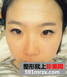 硅胶假体隆鼻+自体脂肪丰额头 驾驭各种发型