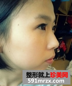硅胶假体隆鼻+自体脂肪丰额头 驾驭各种发型