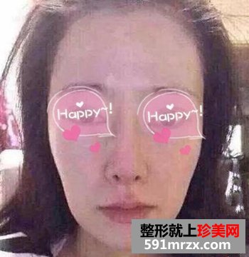 在上海做的自体脂肪填充眼窝+面颊 美了吗