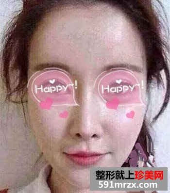 在上海做的自体脂肪填充眼窝+面颊 美了吗
