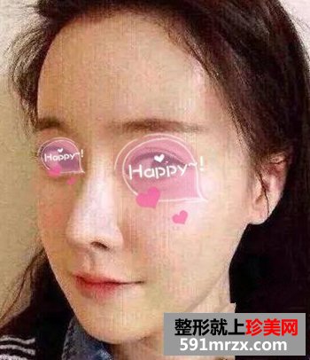 在上海做的自体脂肪填充眼窝+面颊 美了吗