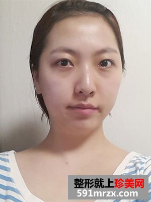 快来围观我的塌鼻子玻尿酸隆鼻前后对比照片
