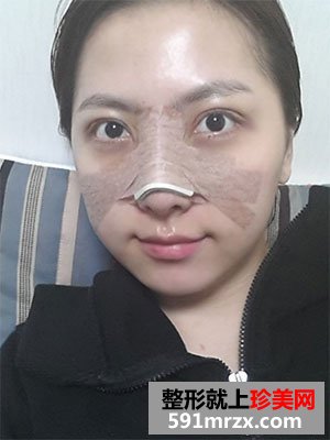 快来围观我的塌鼻子玻尿酸隆鼻前后对比照片