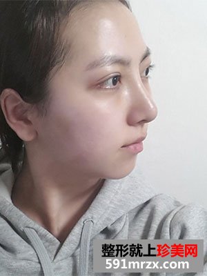 快来围观我的塌鼻子玻尿酸隆鼻前后对比照片