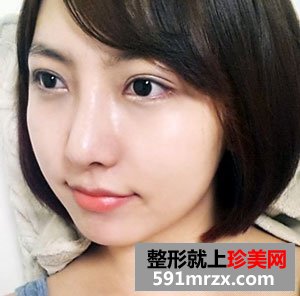 快来围观我的塌鼻子玻尿酸隆鼻前后对比照片