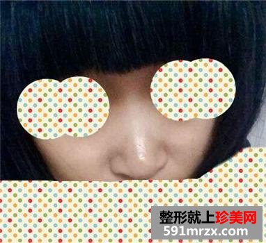 快来围观我的塌鼻子玻尿酸隆鼻前后对比图