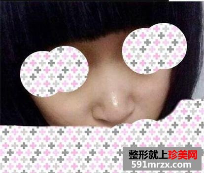 快来围观我的塌鼻子玻尿酸隆鼻前后对比图