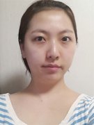 塌鼻子玻尿酸隆鼻前后对比照片