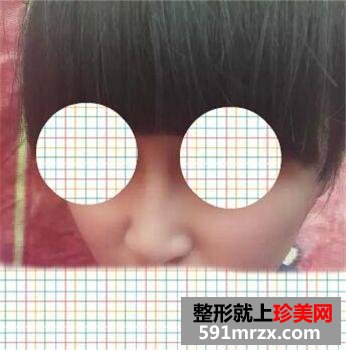 快来围观我的塌鼻子玻尿酸隆鼻前后对比图