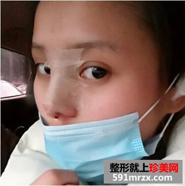 硅胶假体隆鼻好吗 看看我的变化就知道了