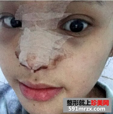 假体隆鼻好吗 我做了假体隆鼻来看看