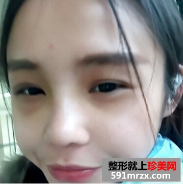 硅胶假体隆鼻好吗 看看我的变化就知道了