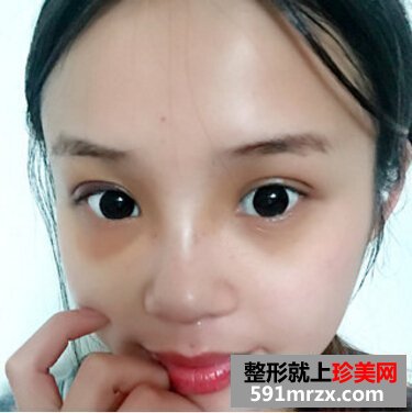 硅胶假体隆鼻好吗 看看我的变化就知道了