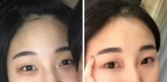 双眼皮手术让我找回自信