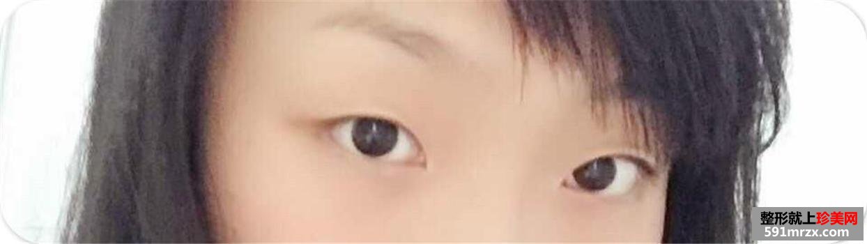 高分子埋线双眼皮 变形计之美丽加减法