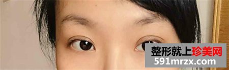 高分子埋线双眼皮 变形计之美丽加减法