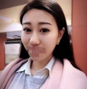 玻尿酸让我变得更漂亮