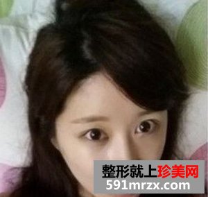 看我开内眼角手术对比照片 眼睛更大了