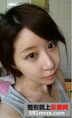 看我开内眼角手术对比照片 眼睛更大了