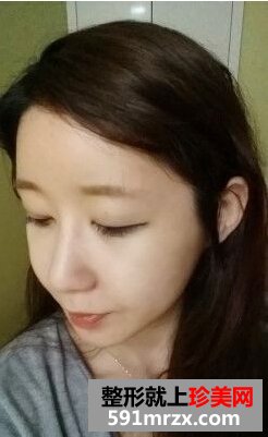 看我开内眼角手术对比照片 眼睛更大了
