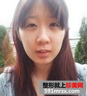 看我开内眼角手术对比照片 眼睛更大了