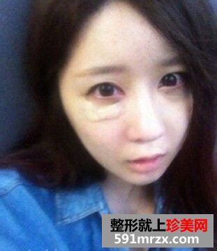 看我开内眼角手术对比照片 眼睛更大了