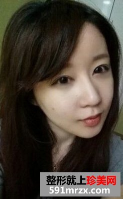 看我开内眼角手术对比照片 眼睛更大了