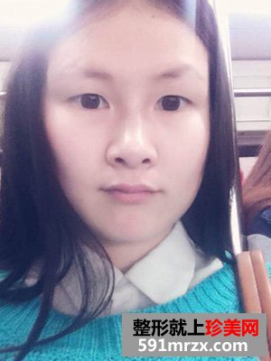 做欧式双眼皮手术的理由很简单 因为喜欢