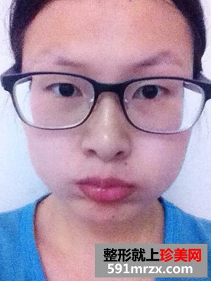 做欧式双眼皮手术的理由很简单 因为喜欢