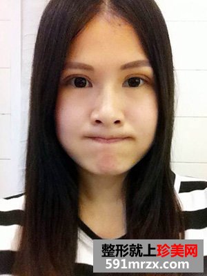 做欧式双眼皮手术的理由很简单 因为喜欢