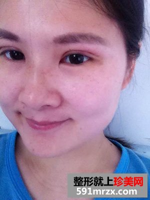 做欧式双眼皮手术的理由很简单 因为喜欢