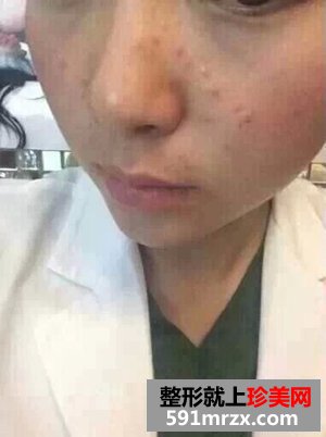 像素激光祛痘印