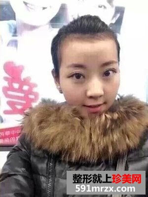 像素激光祛痘印