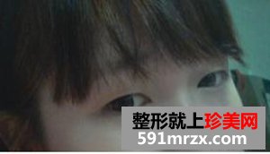 北京韩式双眼皮手术,驼峰鼻矫正方法