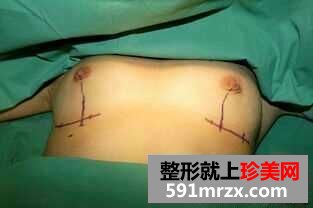 妙桃琴面假体隆胸
