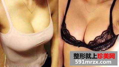 妙桃琴面假体隆胸