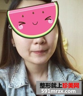 下颌角磨骨整形