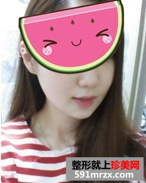 下颌角磨骨整形