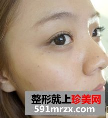 打了美白针之后 你们看效果好吗
