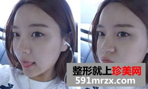 打了美白针之后 你们看效果好吗