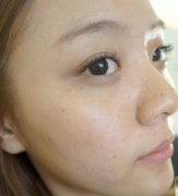 打了美白针你们看效果好吗