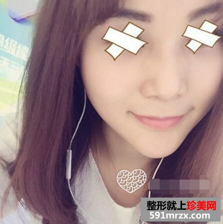 假体隆下巴