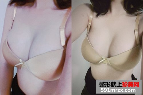 韩国赫尔希假体隆胸恢复日记第三个月