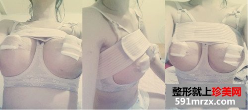 韩国水滴形假体隆胸术后恢复第一个月
