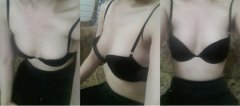 水滴形假体隆胸后让我挺胸做女人