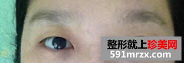 纹眉医院,去纹眉