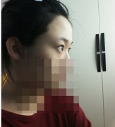 双眼皮埋线几天消肿看看这位妹子的术后恢复过程吧