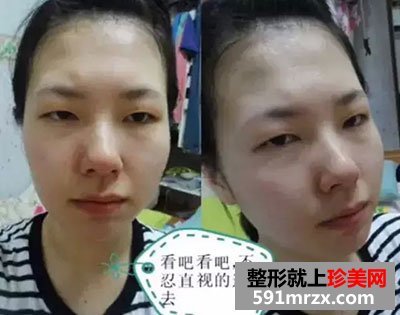 韩式微创双眼皮多少钱